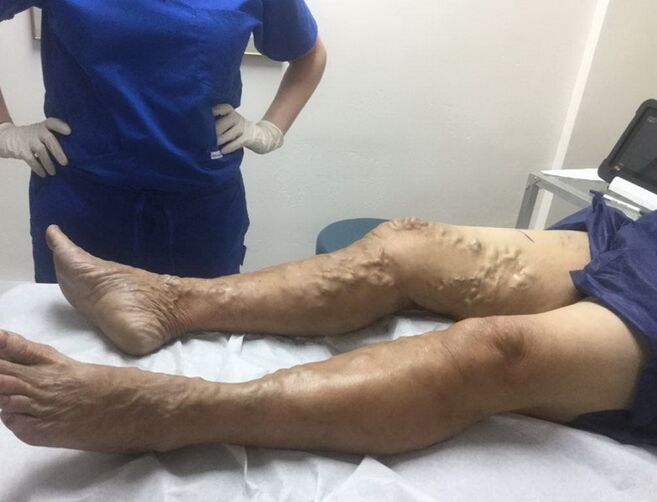 Hogyan lehet felismerni a varikozus jeleit