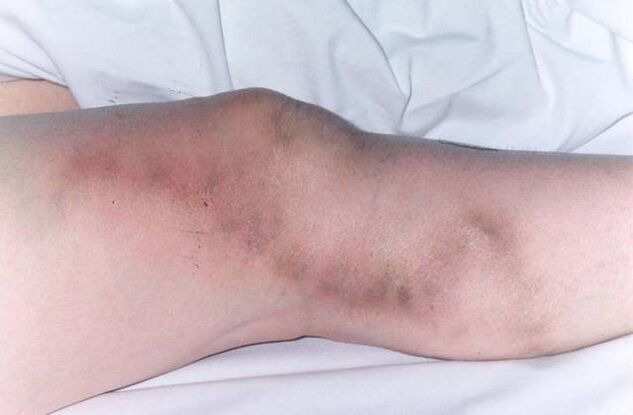 thrombophlebitis előrehaladott visszérrel